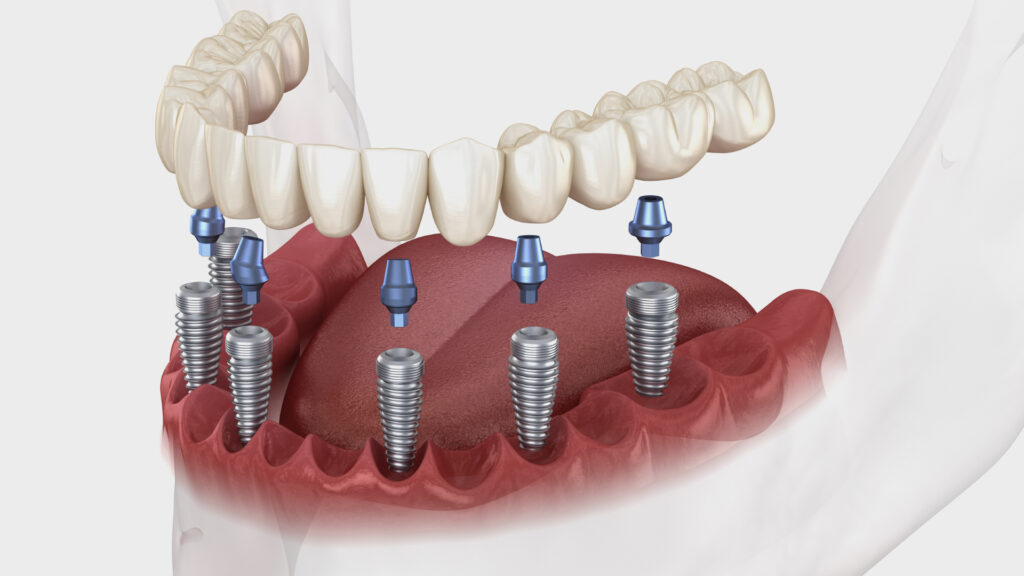 implant dentaire marseille